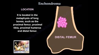 Enchondroma  Everything You Need To Know  Dr Nabil Ebraheim [upl. by Oruasi]