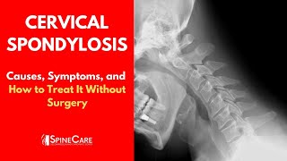 Cervical Spondylosis Causes Symptoms and Treatment [upl. by Atiuqcir819]