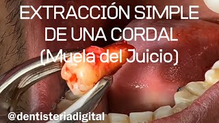 EXTRACCIÓN SIMPLE DE UNA CORDAL Muela del Juicio [upl. by Branch]