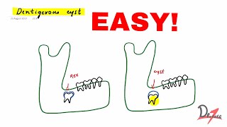 Dentigerous cyst made easy [upl. by Analihp252]