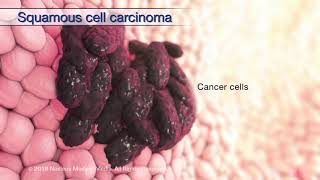 Understanding Head and Neck Cancer [upl. by Lseil]