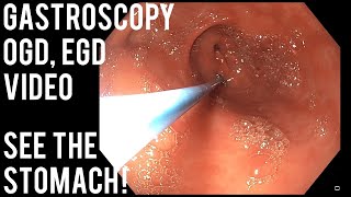 Gastroscopy  OGD  See inside the stomach [upl. by Iey]