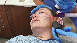 Full Face Fractional CO2 Laser Resurfacing for Wrinkles and Skin Tightening [upl. by Scheld94]