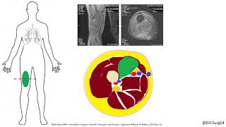 Sarcoma A Rare and Deadly Cancer [upl. by Anitniuq301]