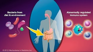 What is Crohns Disease [upl. by Shuman69]