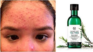 TEA TREE OIL RUINED MY FACE amp How I Cleared it Back Up [upl. by Ekyt]