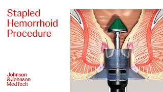 PPH Procedure Animation  Stapled Hemorrhoid Surgery  JampJ MedTech [upl. by Danby]