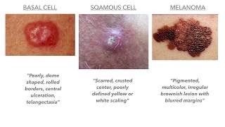 Dermatology on USMLECOMLEX [upl. by Eilatam]