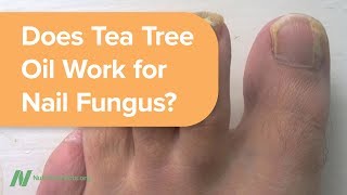 Does Tea Tree Oil Work for Nail Fungus [upl. by Gabler]