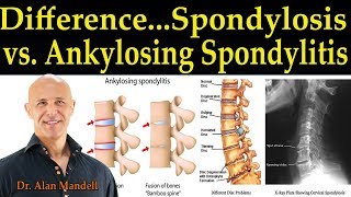 What are the symptoms of cervical spondylosis  Dr Umesh Srikantha  Aster CMI Hospital Bangalore [upl. by Bary337]