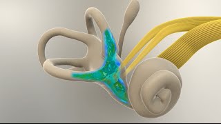 Menieres Disease  What Happens in the Inner Ear [upl. by Engamrahc375]