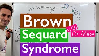 Brown Sequard Syndrome [upl. by Melac]