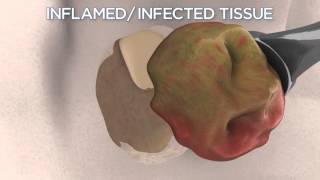 Dental Cyst and Infection Causes Symptoms Types and Treatment [upl. by Elwira725]