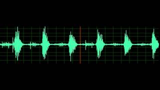 Crackles Pulmonary Edema [upl. by Rekyr]